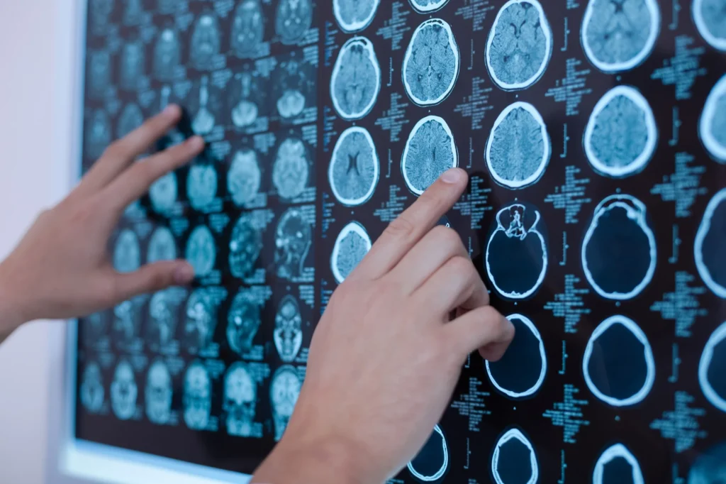 A hand pointing at a series of brain MRI scans displayed on a screen, highlighting areas of interest in the imaging.